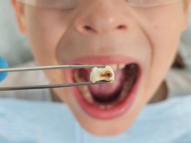 Best Emergency Dentist for Knocked-Out Tooth in Westwood Shores, TX